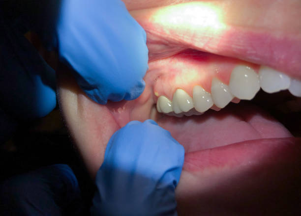 Best Emergency Wisdom Teeth Removal in Llington, MI