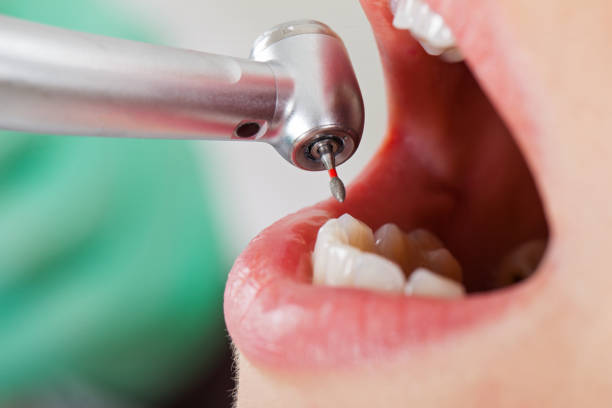 Best Emergency Tooth Extraction in Llington, MI